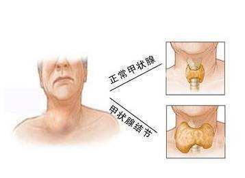 2018年甲状腺结节患者能买什么保险？