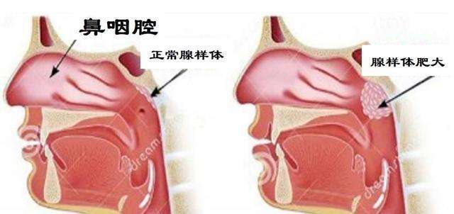 2019年导致鼻咽癌的因素都有哪些？