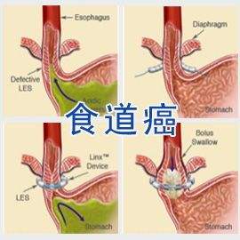 2019年食道癌是如何产生的？