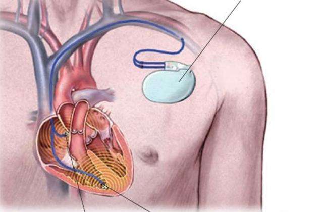 百万医疗险可以报销『心脏起搏器』么？